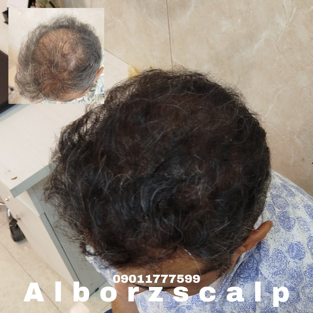 اسکالپ پوششی